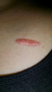 They finally implanted a chest port for Rachel as her veins weren't holding up ot IVs and she was having too many PICC lines. This is the scar.