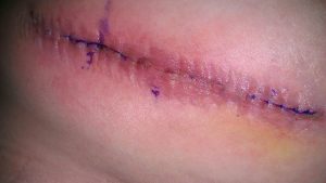 LP Shunt surgical scar.