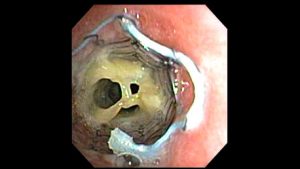 Post tracheobronchoplasty bronchoscopy. Because the mesh was not integrating into the trachealis muscle as it should, they placed a metal stent (usually not used for something like this) to try press the trachealis into the mesh as it would heal. I was on multiple mucus reduction agesnt at the time, as well.