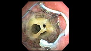 Post tracheobronchoplasty bronchoscopy. Because the mesh was not integrating into the trachealis muscle as it should, they placed a metal stent (usually not used for something like this) to try press the trachealis into the mesh as it would heal. I was on multiple mucus reduction agesnt at the time, as well.