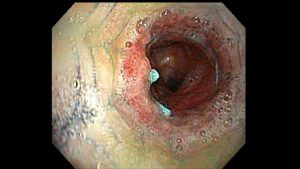 Post tracheobronchoplasty bronchoscopy. Because the mesh was not integrating into the trachealis muscle as it should, they placed a metal stent (usually not used for something like this) to try press the trachealis into the mesh as it would heal. I was on multiple mucus reduction agesnt at the time, as well.