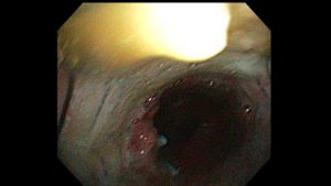 Post tracheobronchoplasty bronchoscopy. Because the mesh was not integrating into the trachealis muscle as it should, they placed a metal stent (usually not used for something like this) to try press the trachealis into the mesh as it would heal. I was on multiple mucus reduction agesnt at the time, as well.