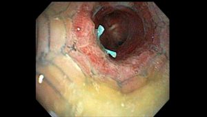 Post tracheobronchoplasty bronchoscopy. Because the mesh was not integrating into the trachealis muscle as it should, they placed a metal stent (usually not used for something like this) to try press the trachealis into the mesh as it would heal. I was on multiple mucus reduction agesnt at the time, as well.